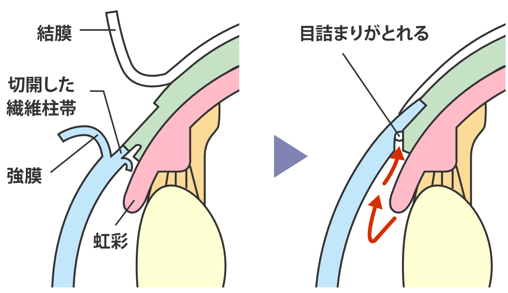 流出路再建術