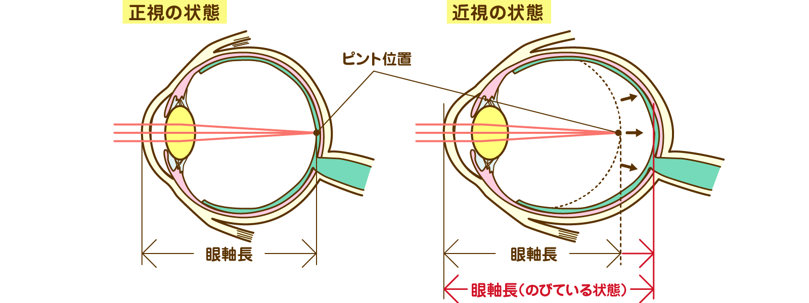 正視の状態、強度近視の状態