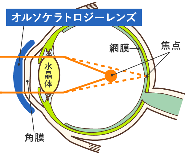 夜:レンズ装用中